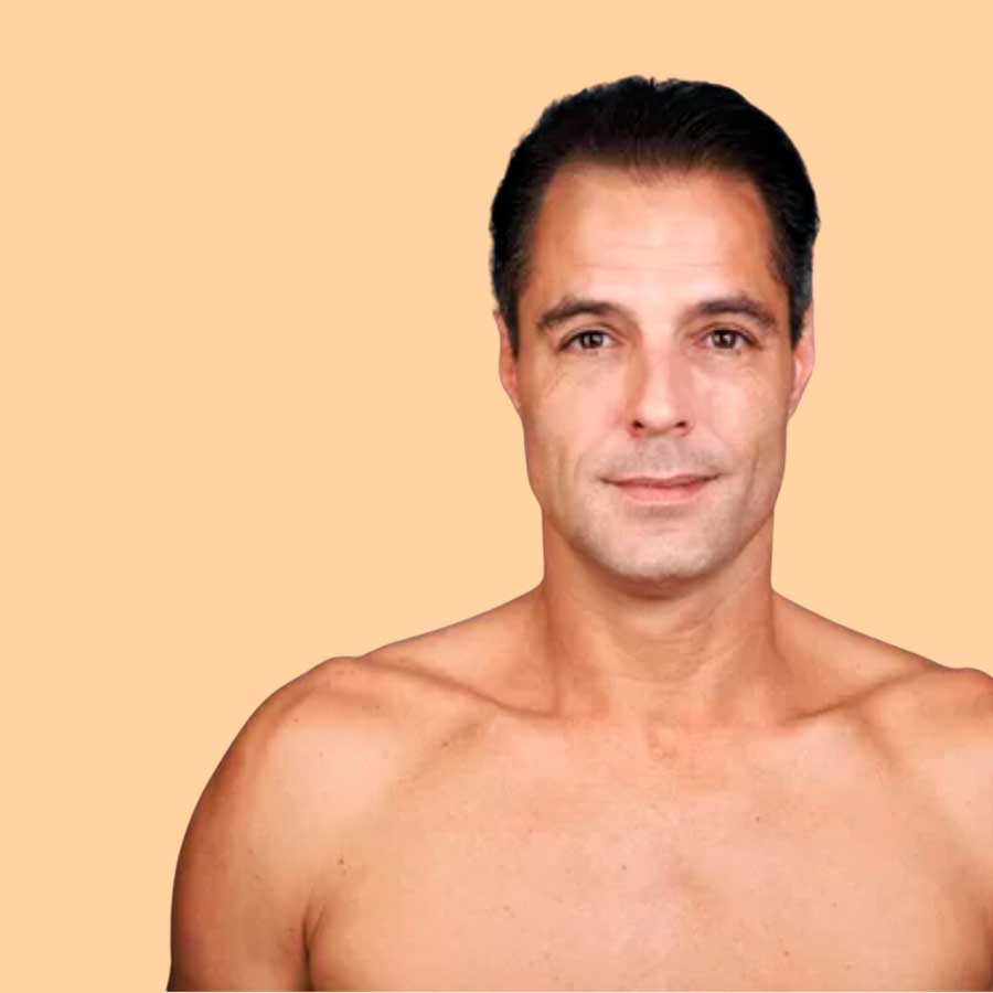 MICRODERMOABRASIÓN 