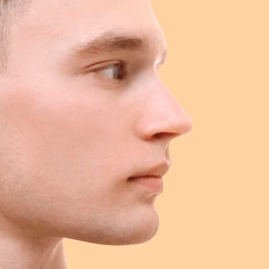 FACIAL PEELING