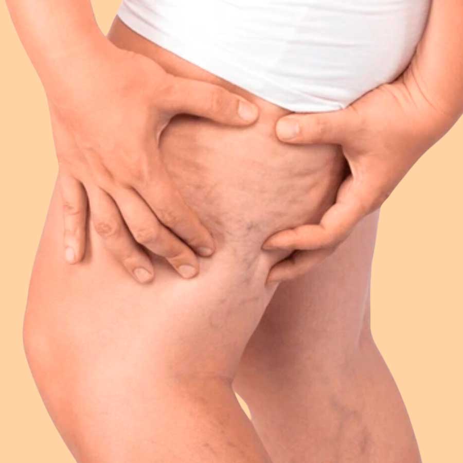 REDUCCIÓN DE MEDIDAS, MANEJO DE FIBROSIS Y CELULITIS