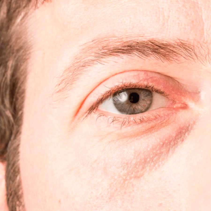 TRAMIENTO PARA OJERAS 