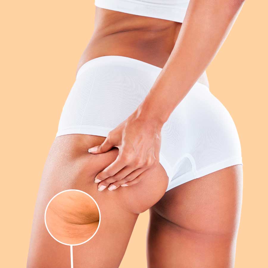 TRATAMIENTO DE MICROAGUJAS PARA LA CELULITIS Y TEXTURA DE LA PIEL 