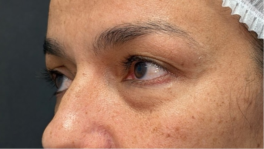 Antes